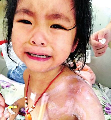 3歲的蘭蘭，全身紅疹，因疼癢難忍而大哭