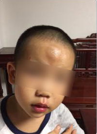 男童被送快遞的電動車撞飛一米多，額頭腫起乒乓球大的包